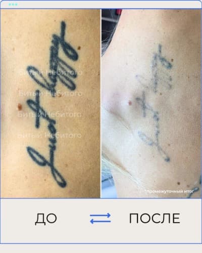 Удаление татуировки